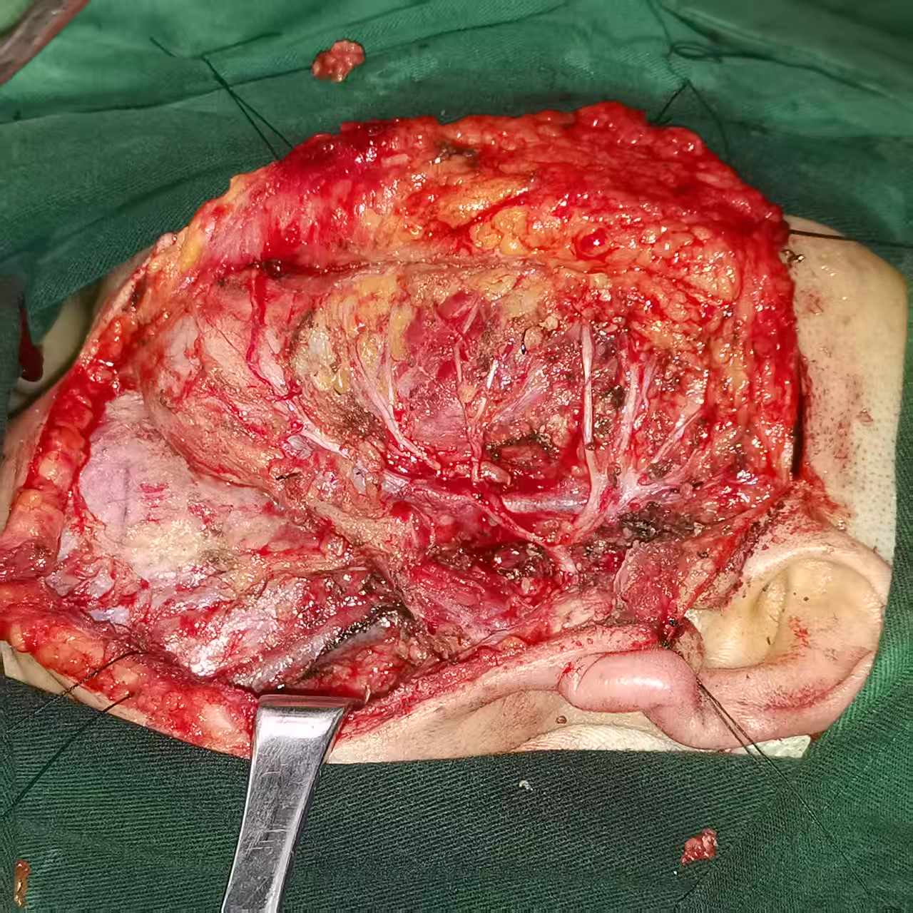 腮腺恶性肿瘤手术术中照片